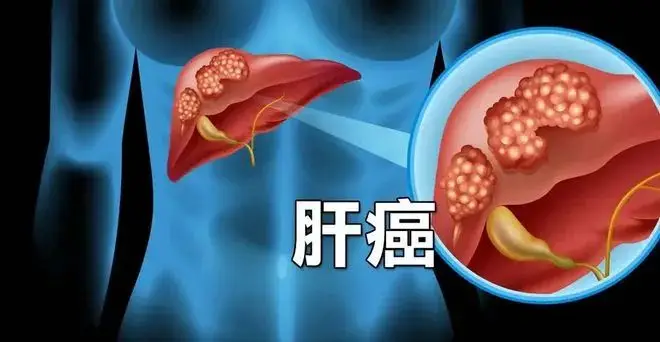肝癌多半是被拖出来的，了解这 3 种异常，为健康保驾护航-Stars柳岸晚风