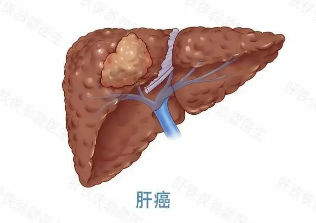 _肝癌行为异常_肝癌异常灌注是什么病