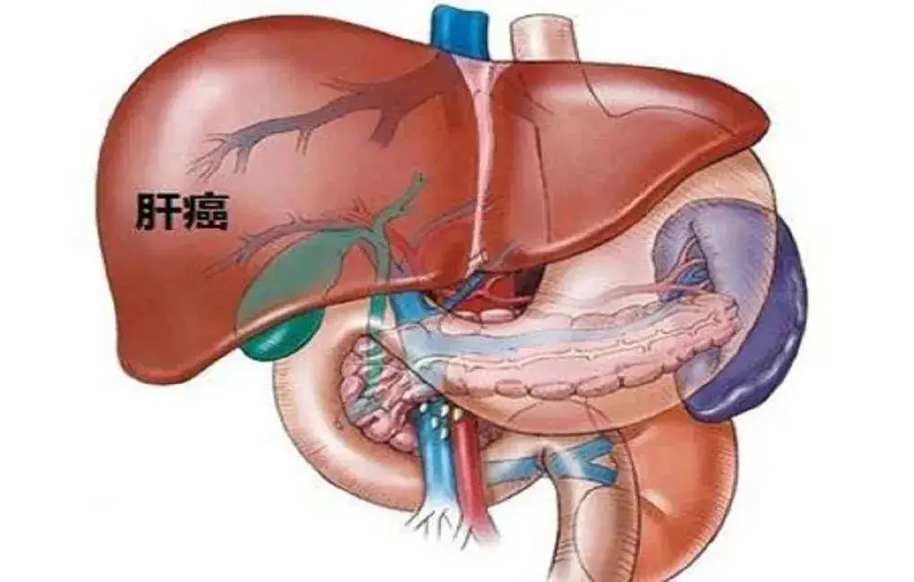 肝癌行为异常_肝癌异常灌注是什么病_